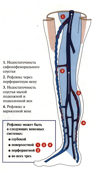 Корнилова схема варикоз